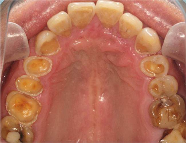 露神经真假辨别,真假露得清颜色