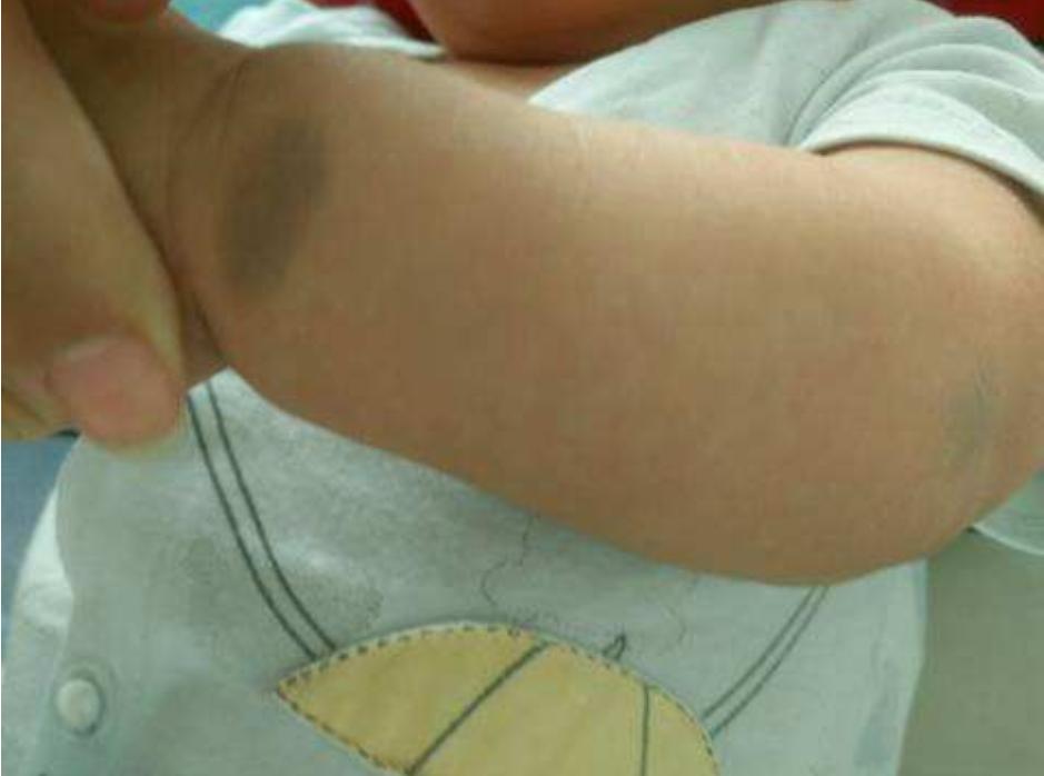 新生儿手臂上有淤青是什么原因,宝宝身上多了淤青什么引起的