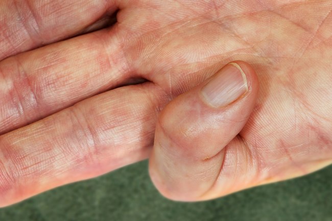 手指头肿了需要去医院吗,单个手指头肿胀要警惕四种病