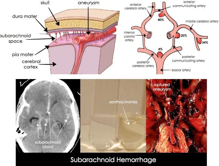 爆炸性头痛,爆炸性神经性头痛