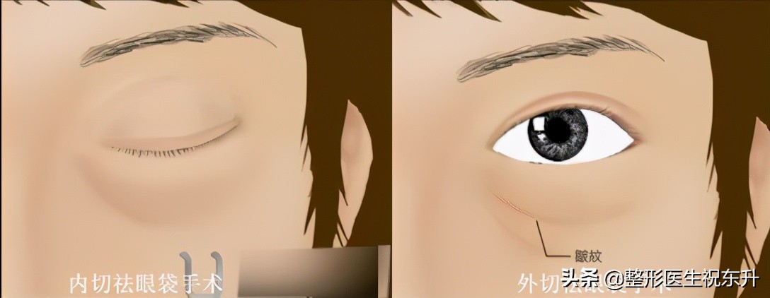 医生科普祛黑眼圈眼袋,祛眼袋医生怎么说