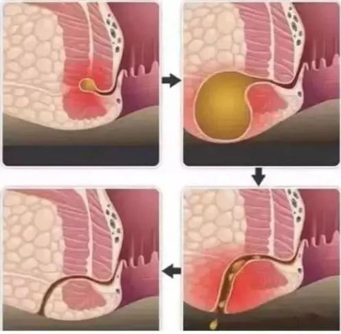得了肛瘘不治疗会怎么样,肛瘘体验