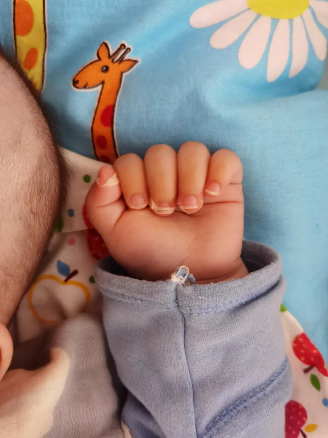 川崎病儿童临床表现,儿童川崎病复发指标