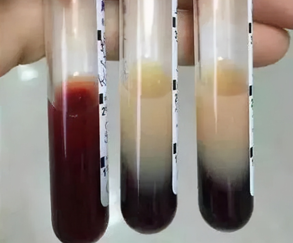 陈以平用海参治疗肾衰,女子吃鸡汤引发急症