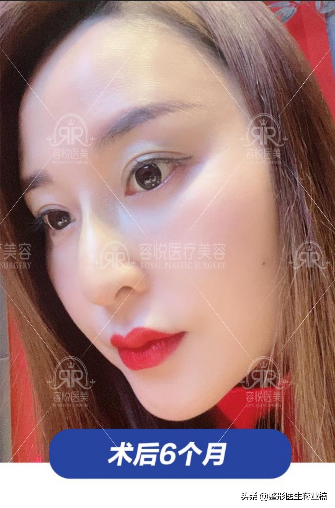 蒋亚楠整形做得怎么样,蒋亚楠整形医生完整视频