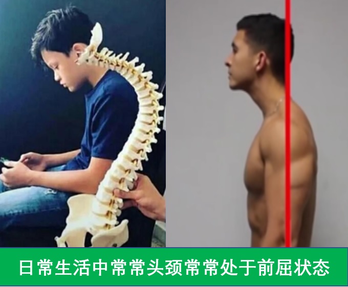 医生说“颈椎曲度变直或者反弓”该怎么办