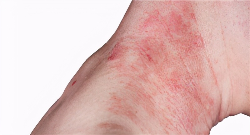 挠痒快速止痒的方法,挠痒快速止痒方法