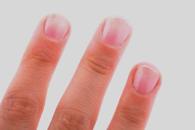 灰指甲应该怎么治医生教你三招,灰指甲为什么会得的