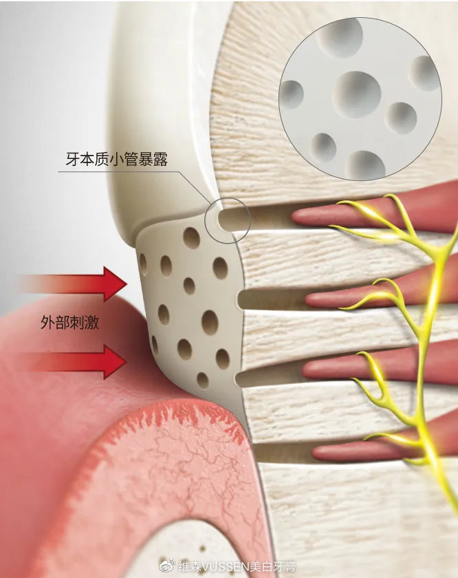 牙科医生推荐的美白牙齿的产品,牙科医生推荐牙膏修复牙釉质
