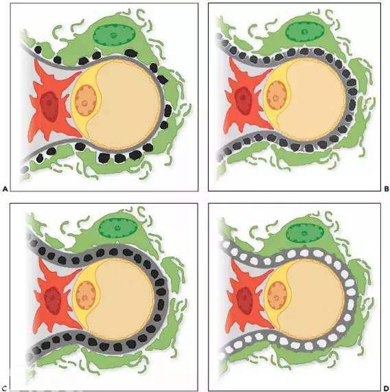 膜性肾病的尿蛋白，为何这么难消除？