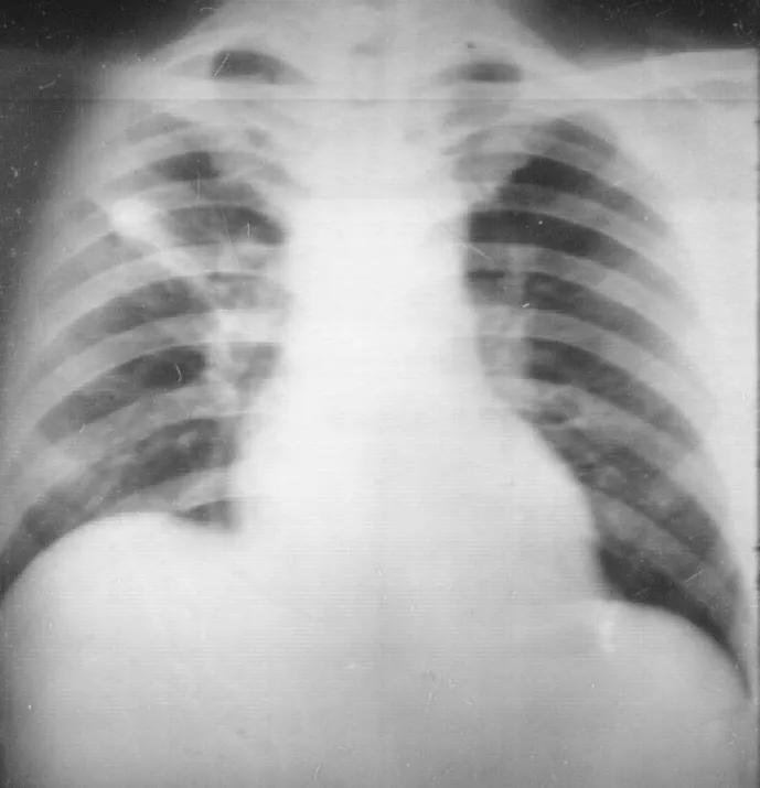 肺结核防控诊疗方案,成功治疗肺结核病的关键