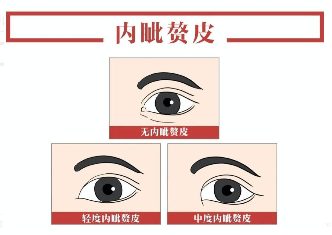 双眼皮手术详细教程,埋线双眼皮手术全过程