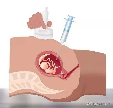 免疫不良妊娠对乙肝有影响吗,预防乙肝母婴传播科普知识问答