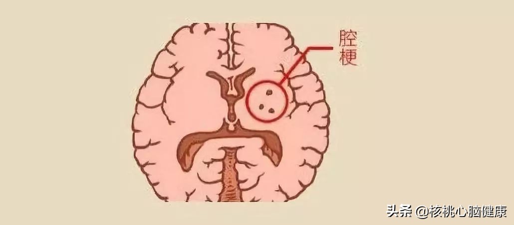 体检出腔隙性脑梗我该咋办,体检查出腔隙性梗塞需要治疗吗