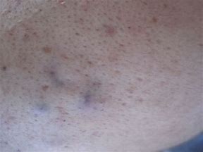 痘痘肌大作战视频教程,痘痘肌的修复