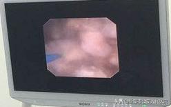 尿结石腰疼说明石头在哪里卡着呢,腰疼得厉害小便血尿是怎么回事