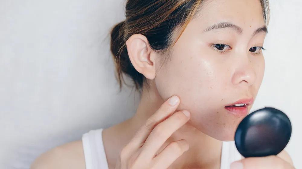 角质层薄想祛痘印做什么医美项目,不用产品就能祛痘印的最佳方法