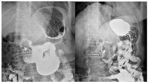 十二指肠球部溃疡解剖位置,十二指肠球部溃疡x线表现