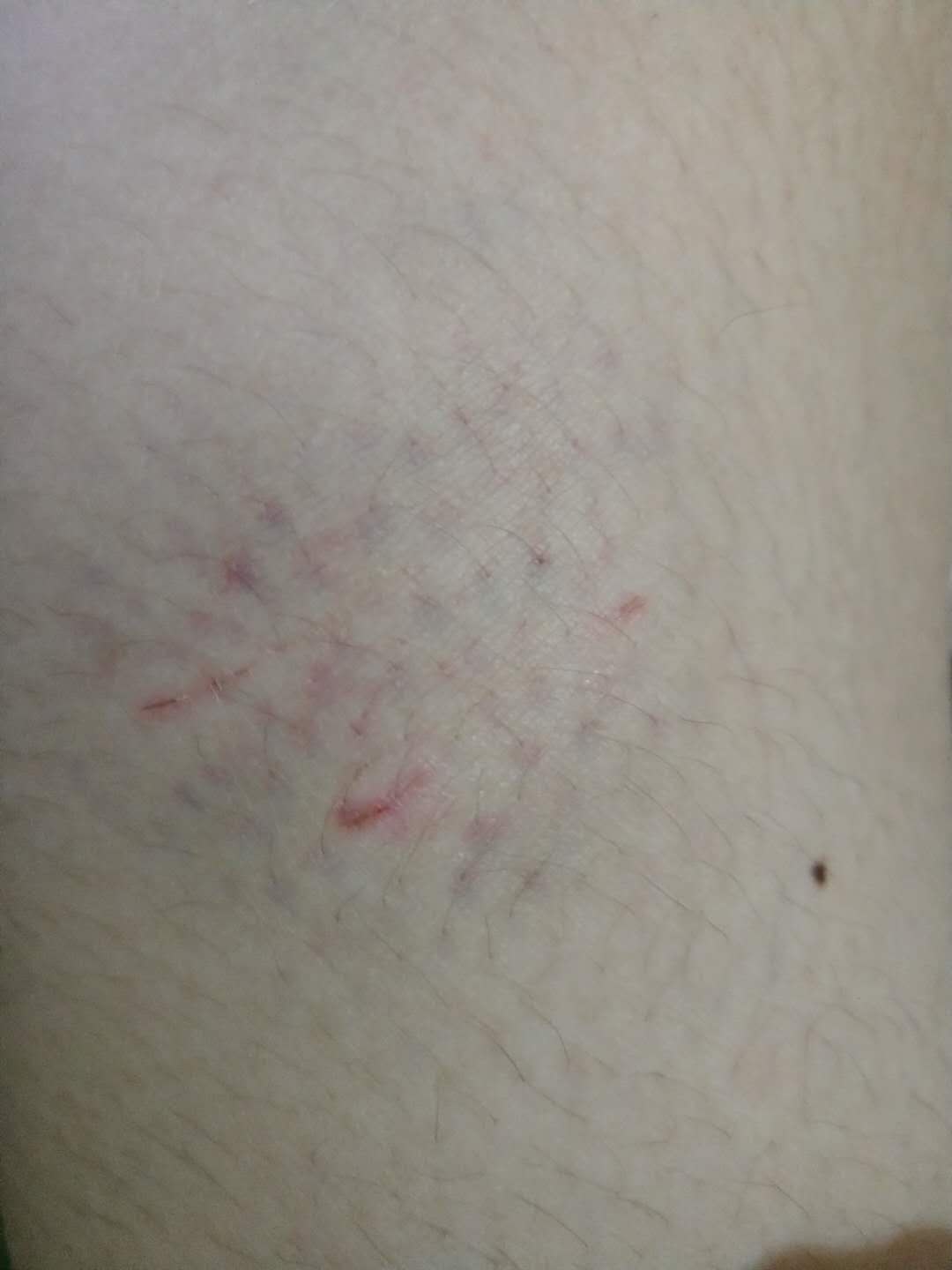 猴子抓伤超24小时打疫苗管用不,被猴子抓了用打疫苗么