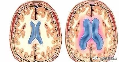 脑出血后脑子里血满了还能治吗,脑出血患者脑子恢复挺好能醒吗