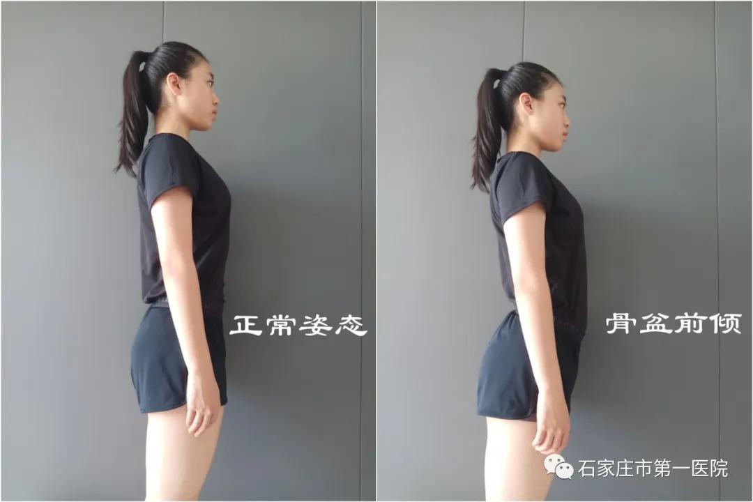 翘臀错误练法,翘臀不正常是什么原因
