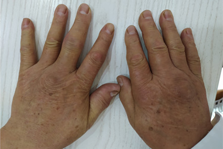 类风湿初期用中药彻底治愈,类风湿用什么方法治疗效果更好