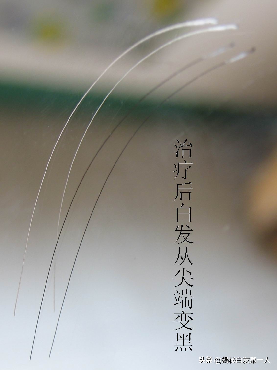 人工肾kidney,为什么kidney是肾脏