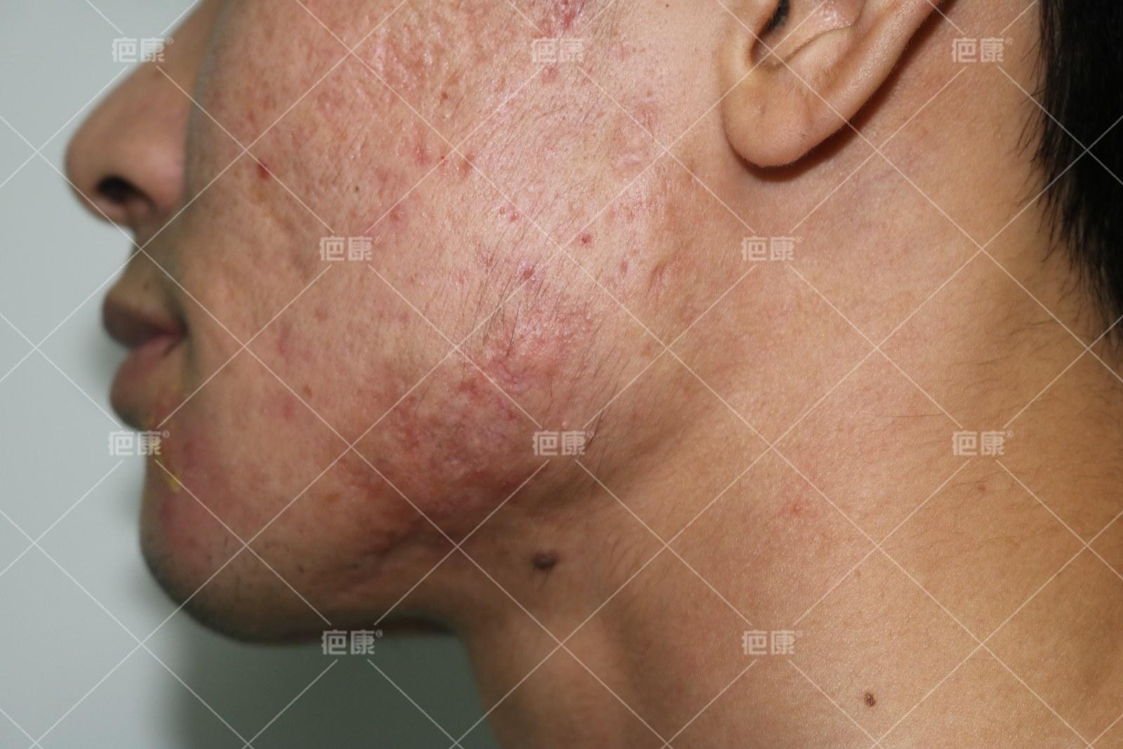 疤康净有效吗,疤康医院能治疤痕疙瘩吗