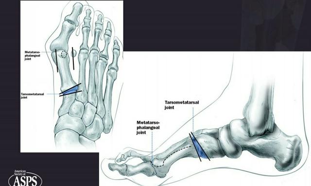 拇外翻大脚趾疼如何在家就能治,大脚拇指痛要警惕