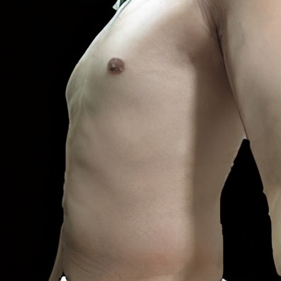 甲亢引起乳房下垂,男性甲亢会引起乳房胀痛吗