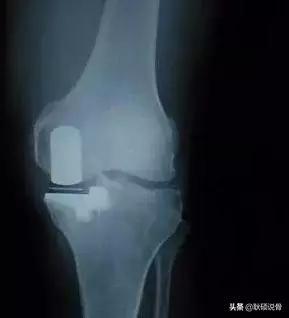 类风湿性关节炎手掌长有骨刺咋办,关节长骨刺一定是创伤性关节炎吗