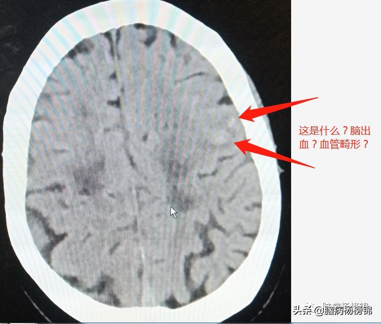 脑出血和脑梗塞同时出现已经昏迷,急性脑梗塞和急性脑出血同时出现