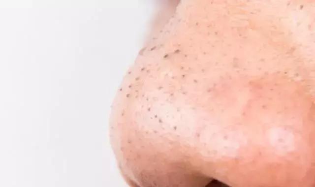 你知道黑头是怎么形成的吗,怎么分辨黑头的严重程度