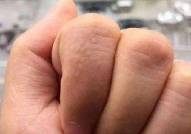 天气一热手上长水泡脱皮,为了避免手上起水泡该怎么预防