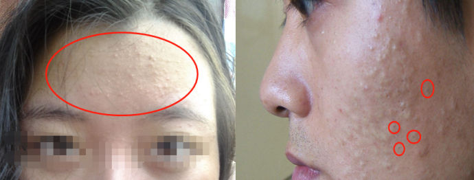 你们的痘痘最后都是怎么完全好的？反正我是用了这个方法才好的