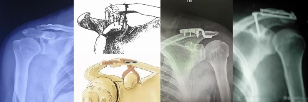 肩锁关节脱位治疗,肩锁关节脱位