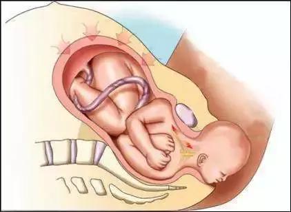 ella产后修复动作,ella产后漏尿做的什么手术