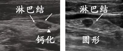 甲状腺术后见异常淋巴结什么意思,甲状腺术后病理有淋巴结转移2枚