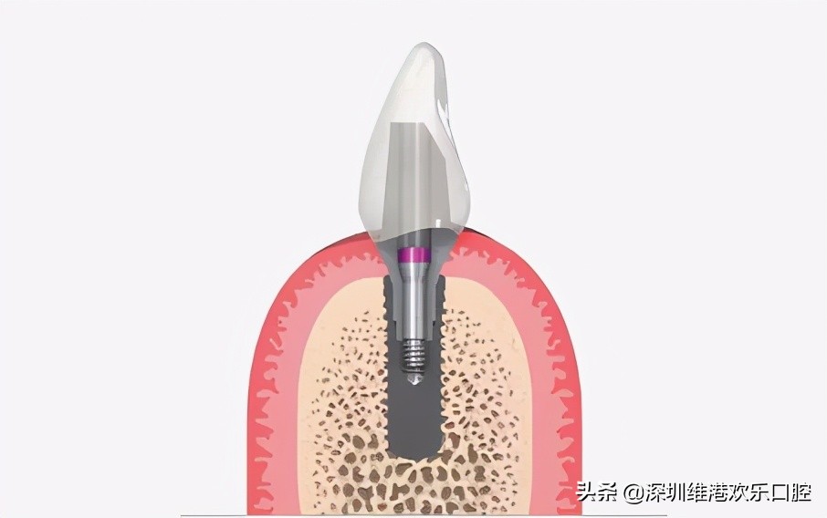 拔牙后为何牙床恢复那么快,拔牙后为啥感觉牙龈外侧塌陷了