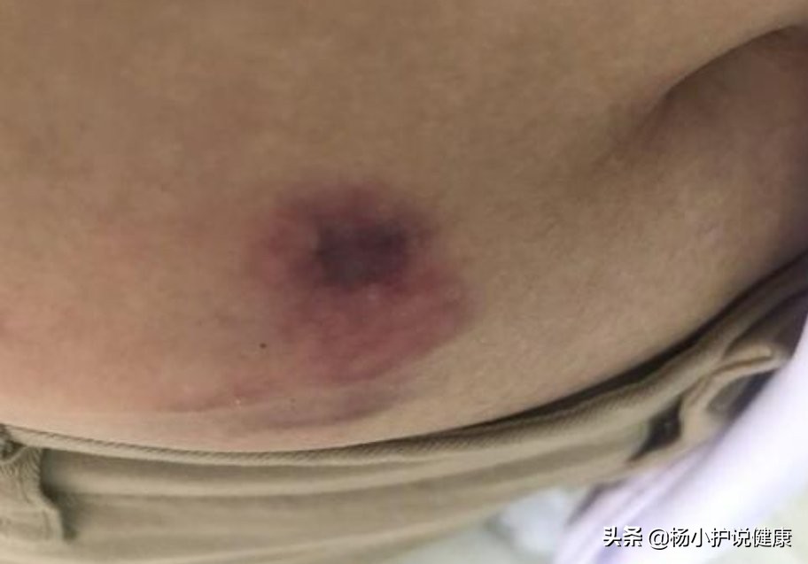 肚皮针应该怎么打，皮肤才没有淤癍？