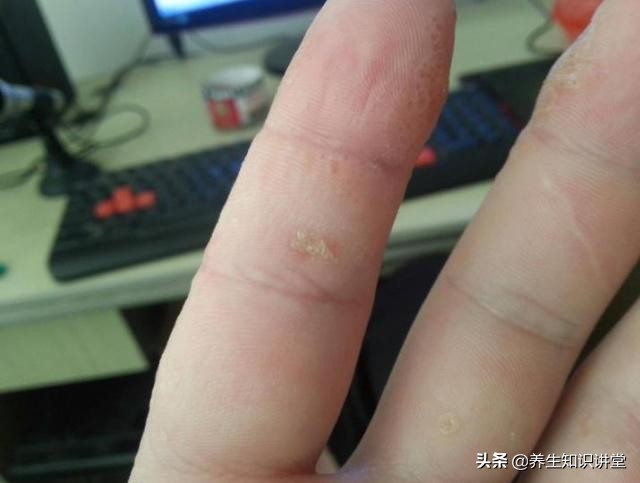 手上长密密麻麻水泡很痒涂什么药,手上长小水泡很痒可以把泡刺破吗