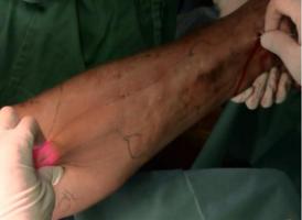 下肢静脉曲张,不怕,医生说可防!可治