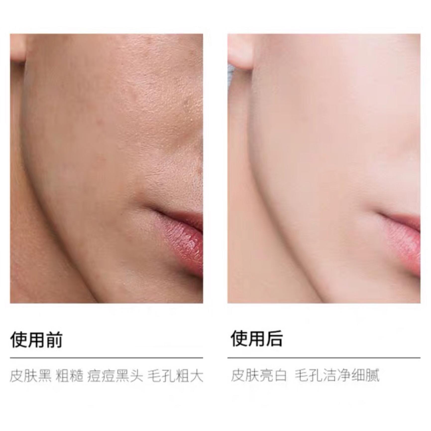 皮肤管理去角质教程,皮肤不好去做什么美容