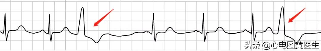 频发室性早搏部分为室性融合波,室性早搏与差异性传导鉴别