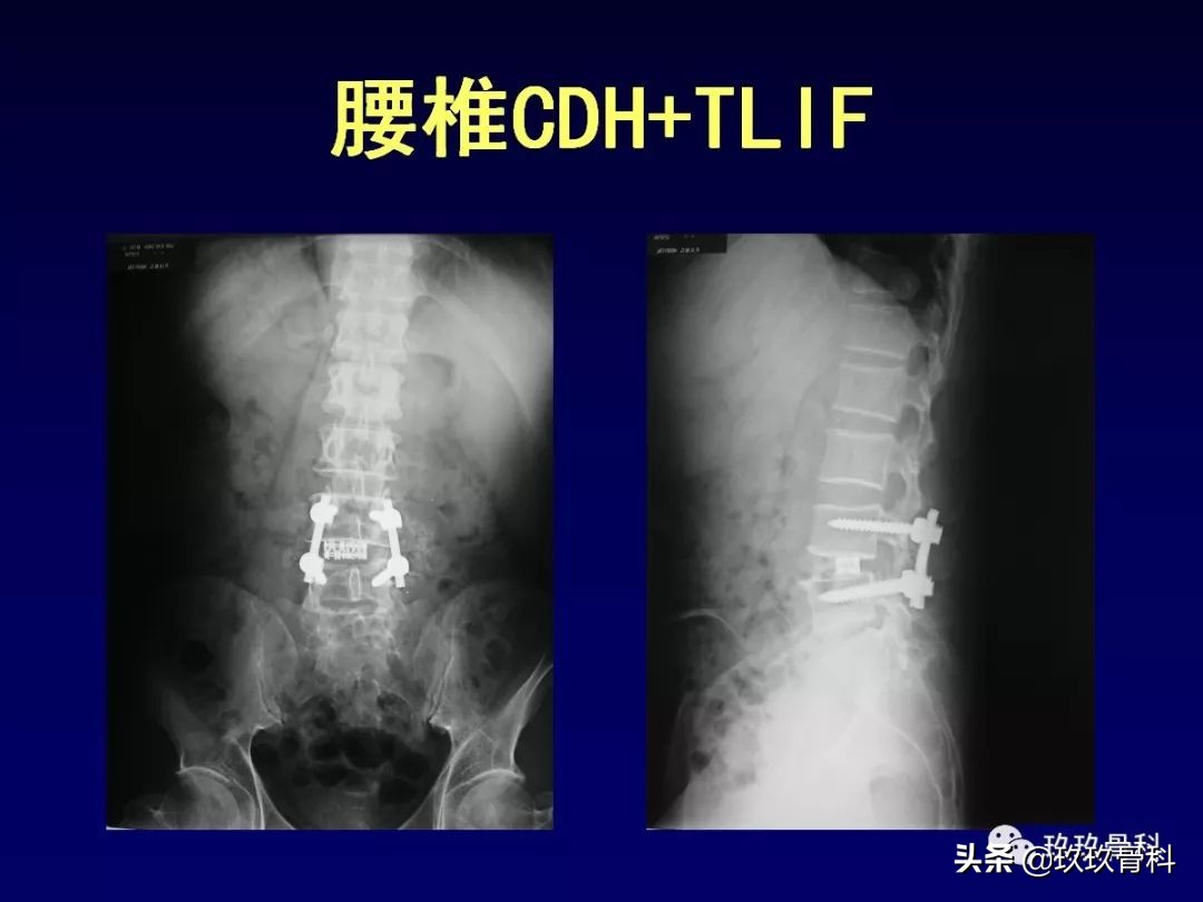 腰椎不稳最坏的结果,腰椎不稳的最佳治疗方法