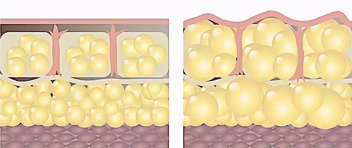 自体脂肪填充苹果肌凹陷,自体脂肪填充苹果肌太高了怎么办