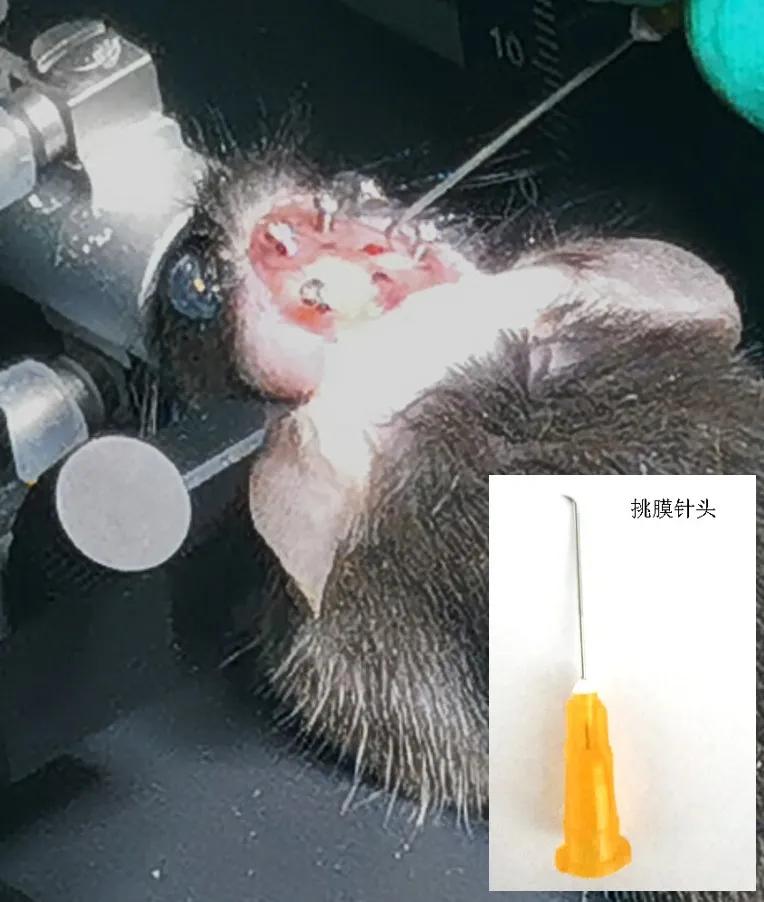 晶体植入手术的分享,可调微丝阵列电极