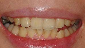 刘涛是全口瓷牙,演员刘涛的一口烤瓷牙多少钱