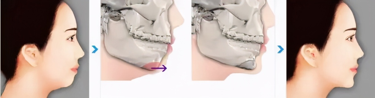 下巴短小和后缩嘴凸起好吗,下巴短小后缩但又有双下巴