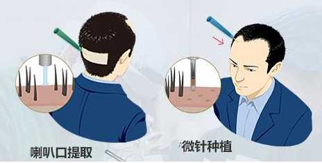 植发效果如何费用贵吗,植发有用吗费用贵吗